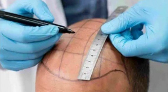 AI-Driven Results: How Technology is Perfecting the Hair Transplant in Riyadh